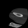SPORK, NICO - 22.03.1976 - 02.08.2022 - CT obere Extremität - 17:51:17